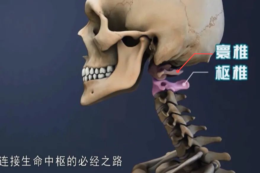 【案例分享】顱底凹陷、寰樞椎脫位，你了解多少？